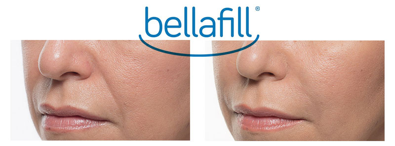 Bellafill Wrinkle Treatment San Diego Neu Look Med Spa