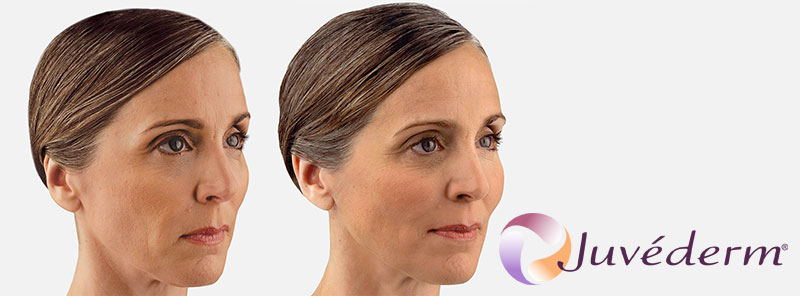 Juvéderm San Diego | Juvéderm Specials | Neu Look Med Spa & Skin Center