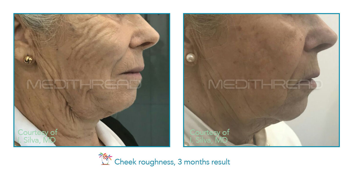 medi thread treatment for cheeks