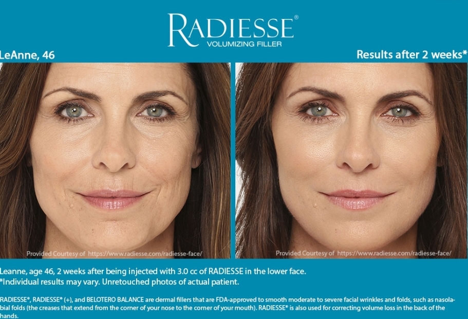Radiesse before and after