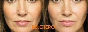 Belotero dermal filler to add volume and smooth wrinkles