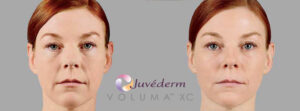 Juvederm Voluma as a cheek filler for cheekbones