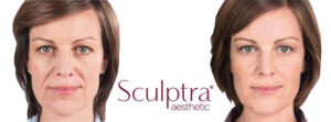 Sculptra cheek dermal filler that increases collagen production