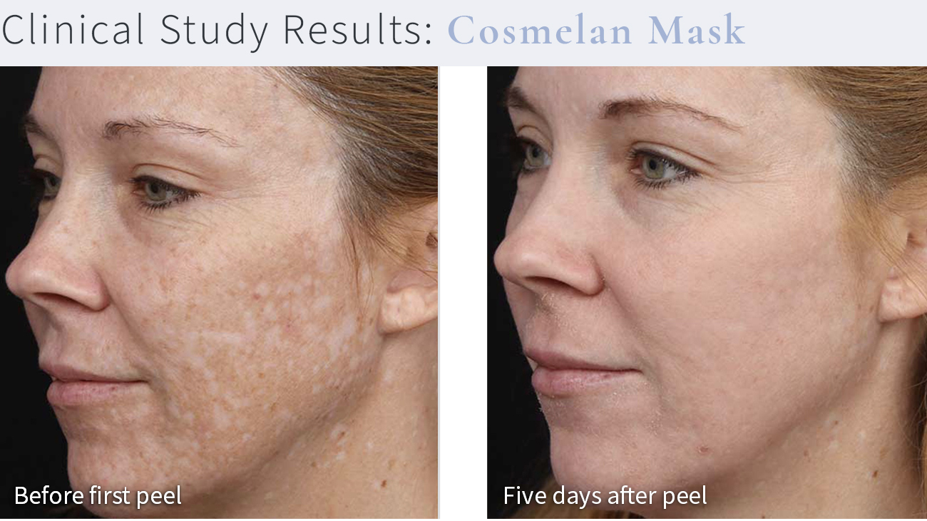 Chemical Peels - Before and After (Cosmelan Mask 2)
