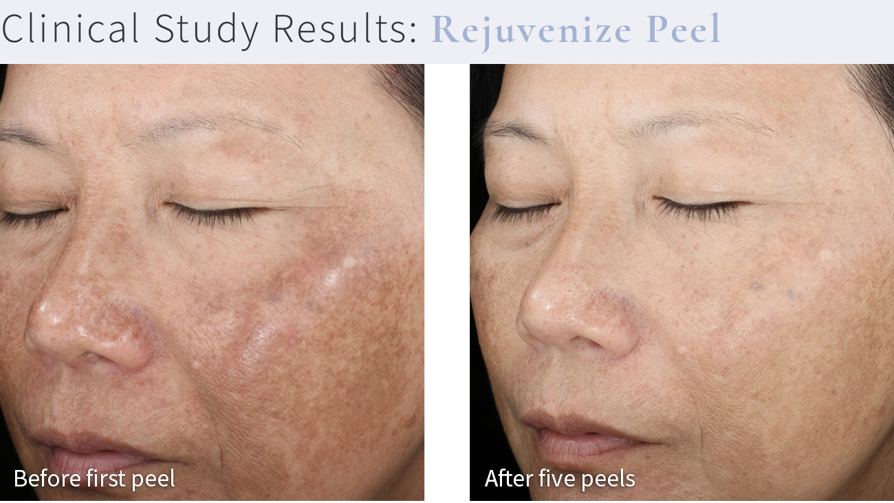 Chemical Peels - Before and After (Rejuvenize Peel)