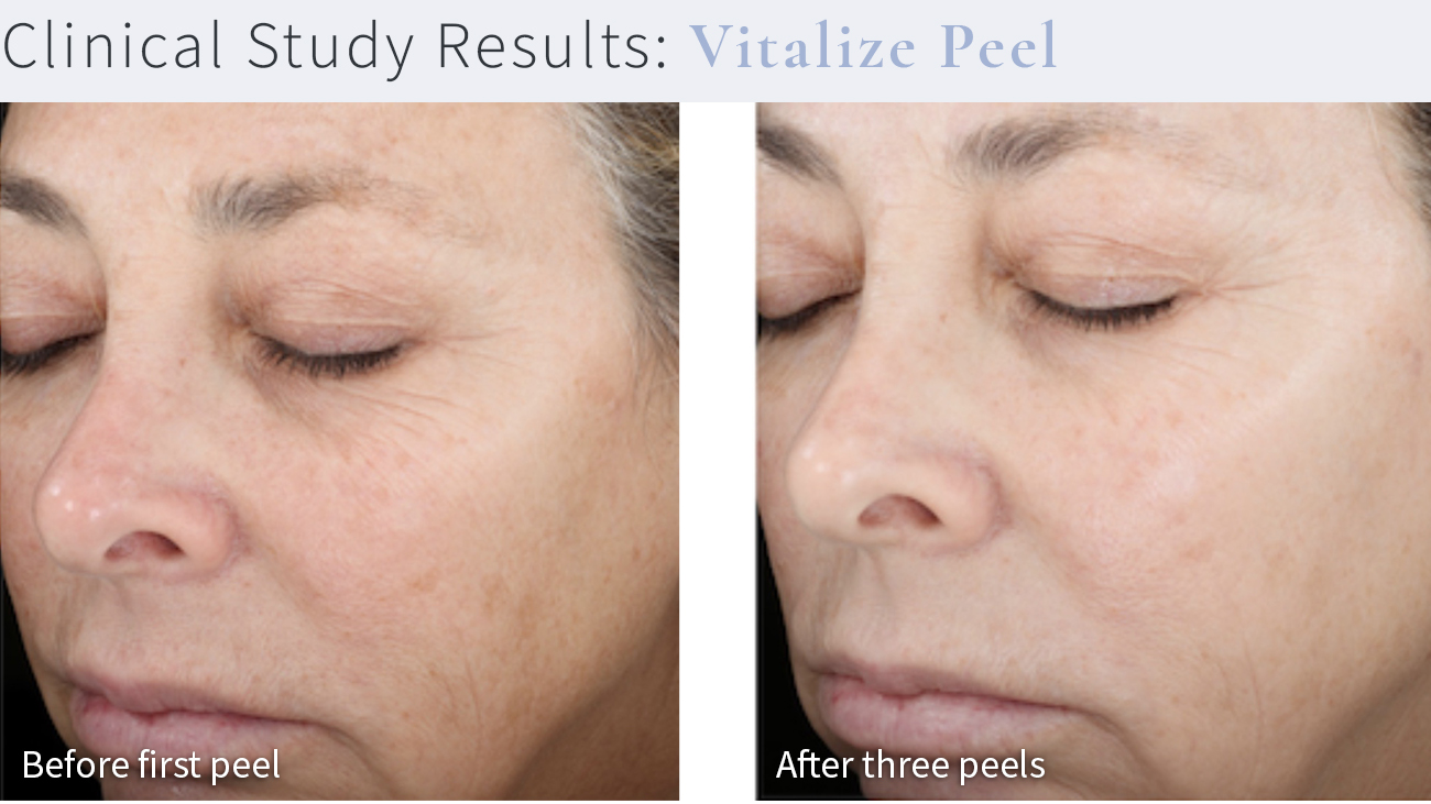 Chemical Peels - Before and After (Vitalize Peel)