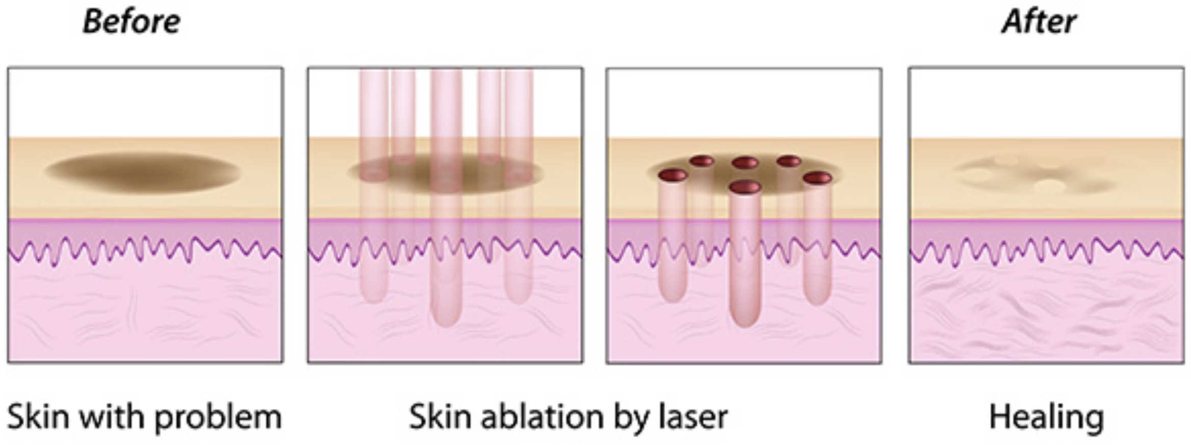 About Fractional Laser Skin Resurfacing