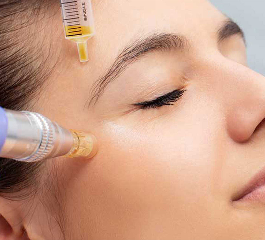 PRP Microneedling San Diego CA