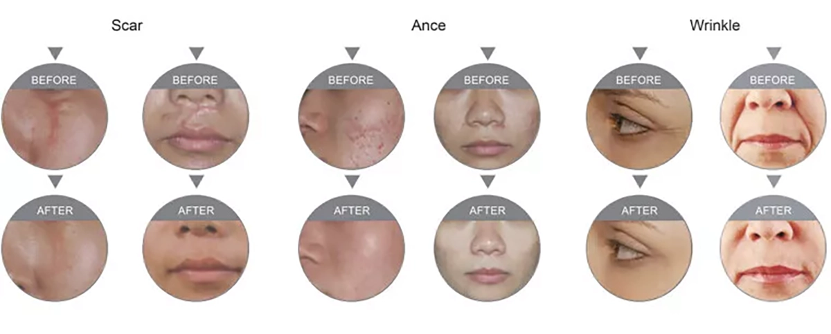 Before and after fractional laser treatment for scar acne and wrinkles