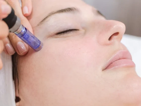 Close-up of a professional performing microneedling with PRP on a patient's face, highlighting the precision and care in the procedure